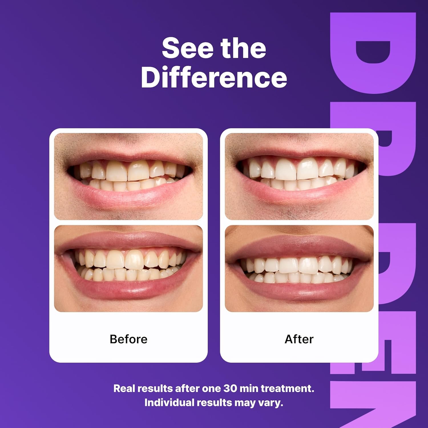 Radiant Smile Whitening Strips